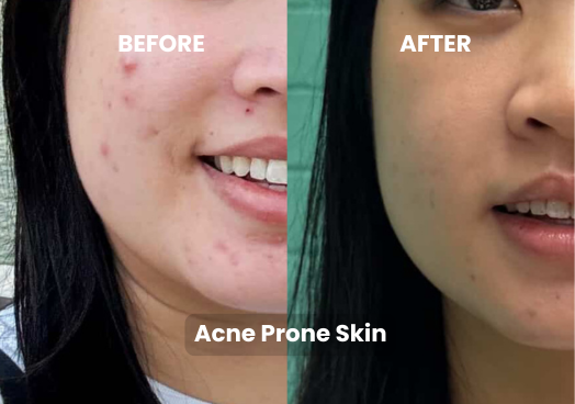 Matcha Mask Refill Bundle – 15 Masks